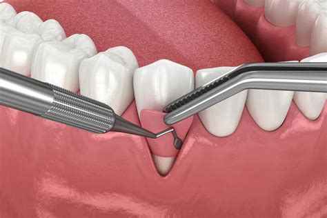Gum Graft Surgery: Types And Recovery Insights