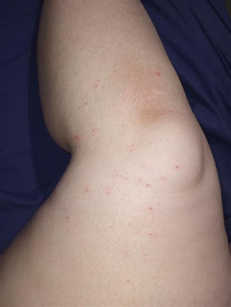 Pimples on my legs? : r/pimplecommunity