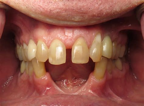 Bone Grafting or No Bone Grafting? - Ramsey A. Amin DDS