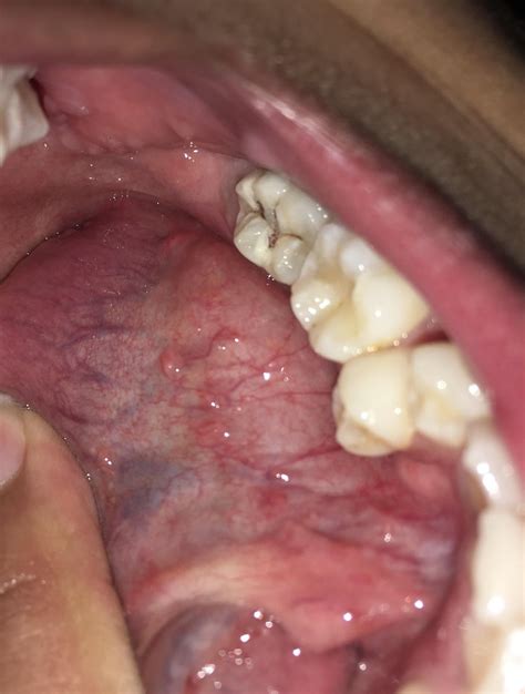 Bumps under tongue help idk what it is : r/medical