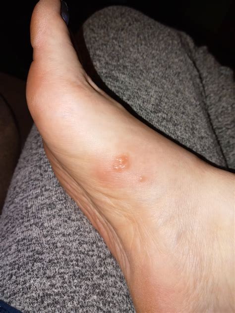 Little Bumps On Inside Of Foot Best Sale | emergencydentistry.com