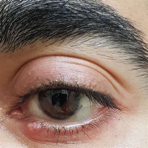 Swollen Upper Eyelid Stye
