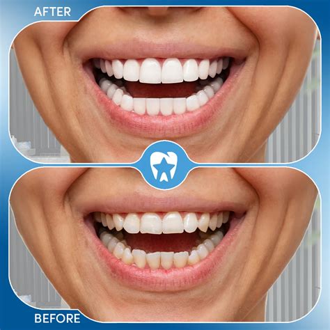 Composite Veneers in Turkey - Cost and Packages in 2026