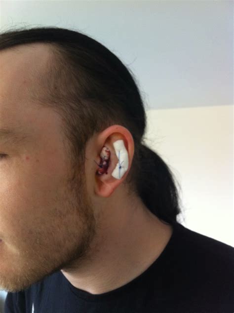 Cauliflower Ear Plastic Surgery at Terry Camacho blog