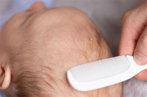 What Causes Cradle Cap in Newborns and How Can It Be Handled? - Robustalive