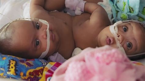 Fort Worth: Cook Children's conjoined twins separated | wfaa.com