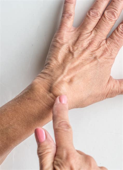 Ganglion Cyst | Orthopedic Centers of Colorado