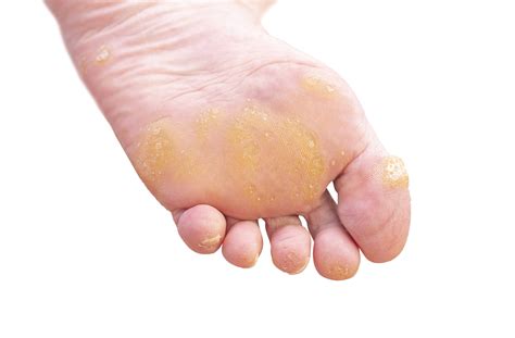 Corns And Callus Treatment - Top Tips - The Healthcare Hub