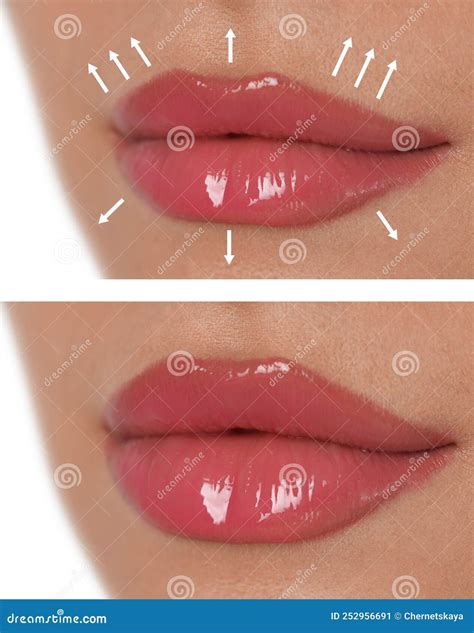 Collage with Photos of Young Woman before and after Lips Augmentation Procedure, Closeup Stock ...