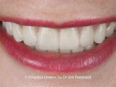 Porcelain Crown Anterior Teeth at James Depew blog