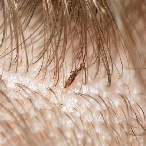 Stages Head Lice