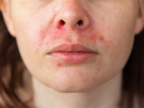 What Is Perioral Dermatitis? | Superdrug Online Doctor