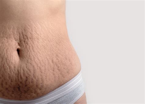 Taylor Swift Stretch Marks