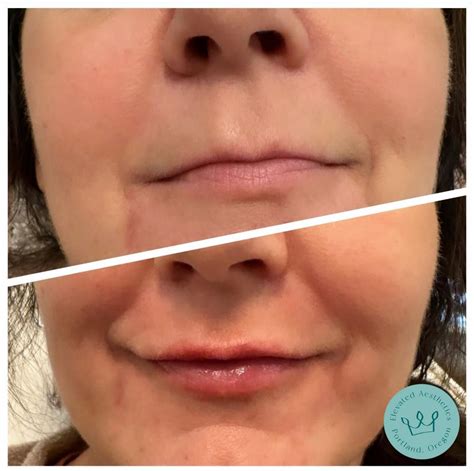 Elevated Aesthetics Results - Elevated Aesthetics