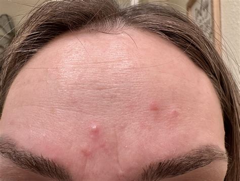 Forehead acne : r/acne