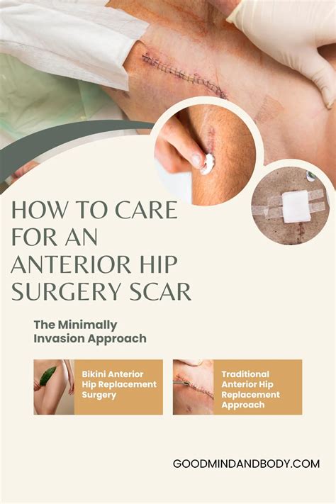 How to Care for an Anterior Hip Replacement Scar - Good Mind and Body