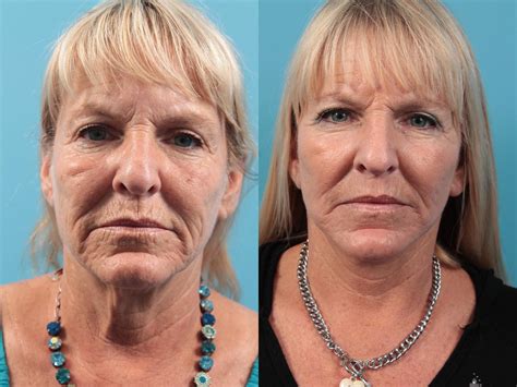 What Is A Laser Facelift at Amy Heyer blog