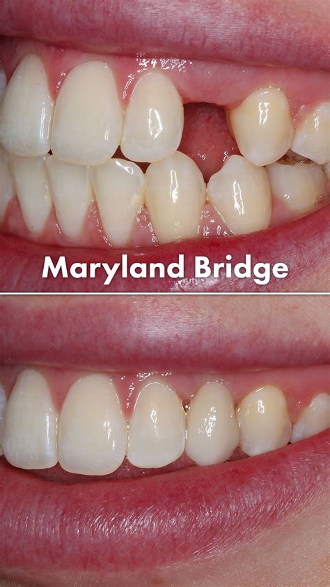 Maryland Bridge Case | Tooth bridge, Dental treatment, Dental