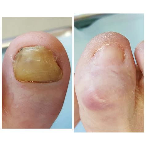Toe Nail Avulsion Injury at Sherlyn Weyer blog
