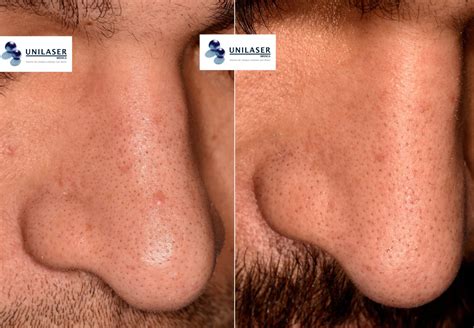 Elimination of the Papules Fibrous of the To the Nasal – UNILASER MÉDICA