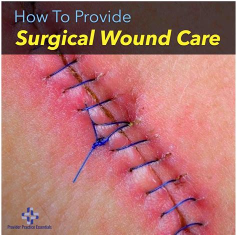 Scar Wound Care at Rita Skelley blog