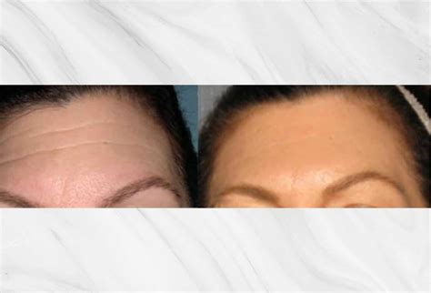 Botox & Neuromodulator Treatment in NYC | Roy Geronemus, MD