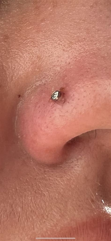 Nose Piercing Infection Bubble Piercing Bump & Keloid Removal: Expert