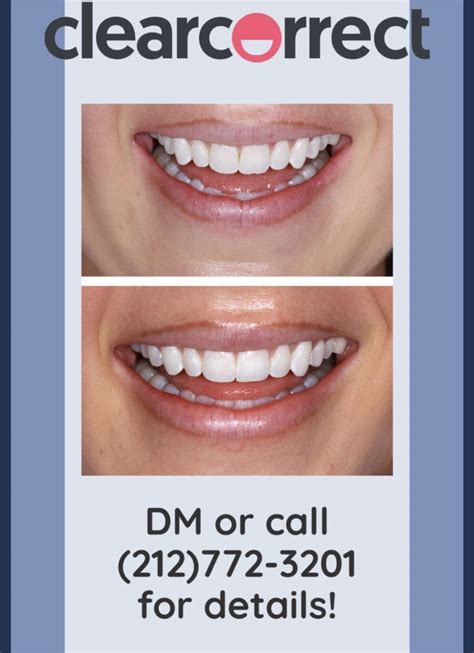 My Experience with ClearCorrect Aligners - Amy Littleson