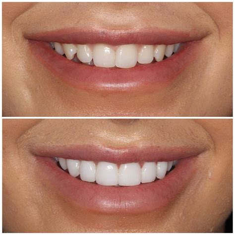 Top 4 Front Teeth Veneers at Latonya Langley blog