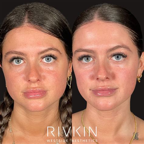 TMJ - RIVKIN Aesthetics