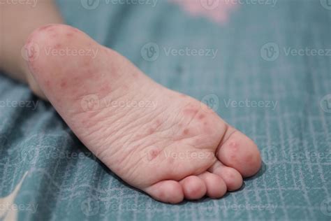 close up view of child's feet infected with hand feet and mouth disease or HFMD originating from ...