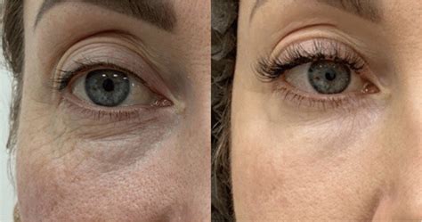 Laser eyelid tightening | Skin Marceau | Paris 16