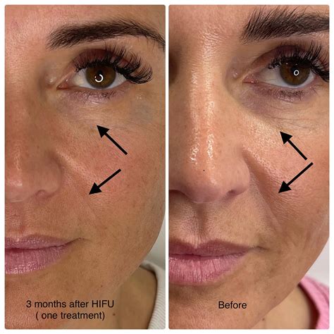 HIFU Services | For Face And Body Treatments | SkinZest