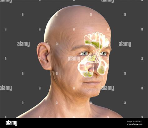 Sinus infection, or sinusitis, computer illustration. The sinuses are membrane-lined air-filled ... - illustration of sinuses