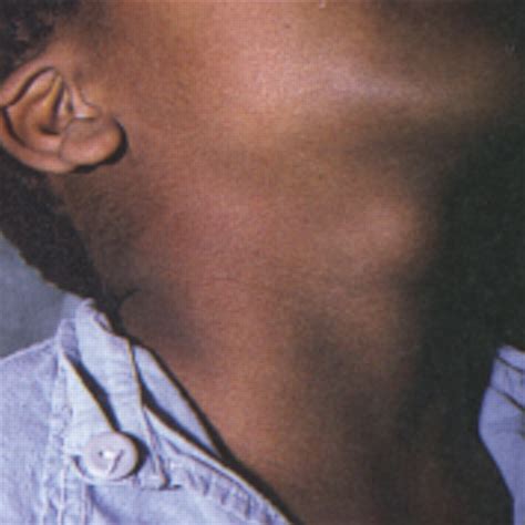 ABC of General Surgery in Children: LUMPS AND SWELLINGS OF THE HEAD AND ...