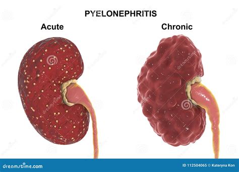 Concept Of Pyelonephritis, Diseases And Kidney Stones, Cystitis, Vector ...