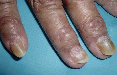 Repairing Nail Bed Damage at James Jain blog