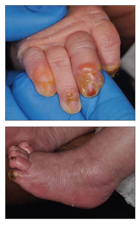 Blistering Lesions in a Newborn | MDedge Dermatology