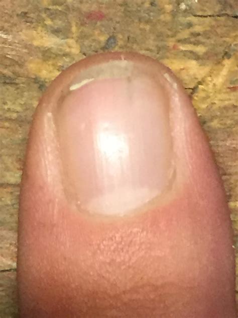 This splinter under my fingernail. : r/mildlyinfuriating - splinter under fingernail