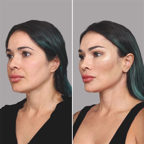 Buccal Fat Removal Before and After Photo Gallery - NewBeauty