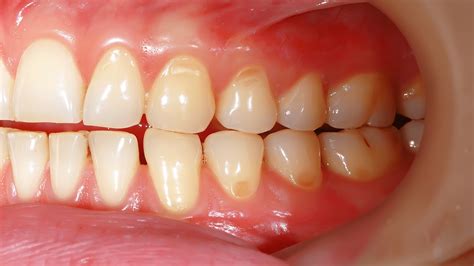 Repair Receding Gums At Home-Healing And Repairing Receding Gums