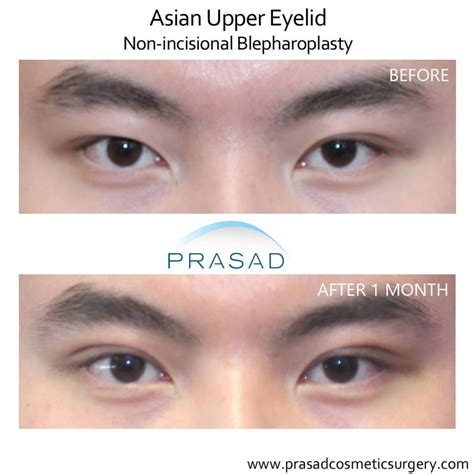 Uneven Eyes Celebrities