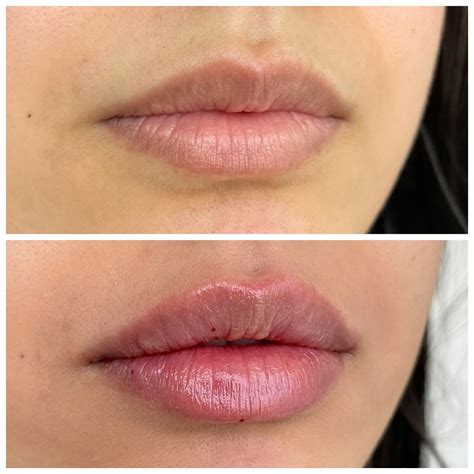 Denver Botox - Boulder Botox - Best Medspa | Lip Filler, Injectables
