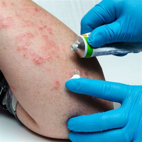 Is Eczema Contagious? (The Truth You Need to Know)