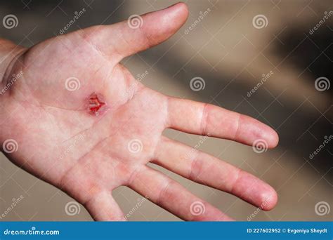 Cierre Del Callo Sobre La Mano Humana Frotando Sobre El Cierre De La ...