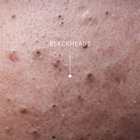 Let’s Talk Blackheads – Causes, How They Look, and How to Treat Them Blackheads can be ...