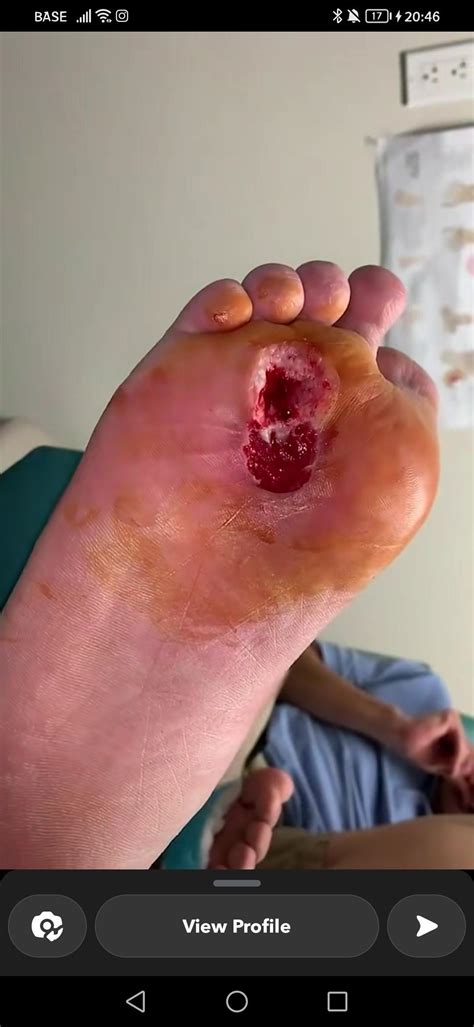 Hole In Callus On Bottom Of Foot Outlet | emergencydentistry.com