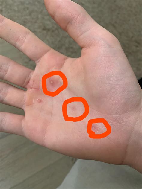 Small pimple-like bumps appearing on my palm after blister burst. They ...
