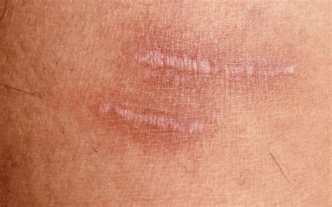 Natural Remedies to Fade Burn Scars | The Derm Spot