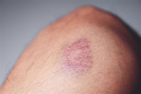 bruised on knee - wound bruised on leg caused by sports and bump or ...